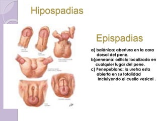 Hipospadias 
Epispadias 
a) balánica: abertura en la cara 
dorsal del pene. 
b)peneana: orificio localizado en 
cualquier lugar del pene. 
c) Penepubiana: la uretra esta 
abierta en su totalidad 
Inclulyendo el cuello vesical . 
 