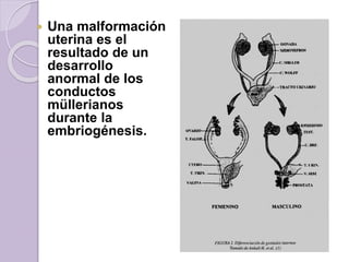  Una malformación 
uterina es el 
resultado de un 
desarrollo 
anormal de los 
conductos 
müllerianos 
durante la 
embriogénesis. 
 