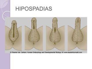 HIPOSPADIAS 
 