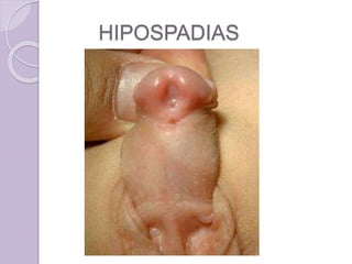 HIPOSPADIAS 
 
