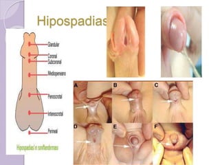 Hipospadias 
 