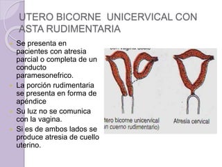 UTERO BICORNE UNICERVICAL CON 
ASTA RUDIMENTARIA 
 Se presenta en 
pacientes con atresia 
parcial o completa de un 
conducto 
paramesonefrico. 
 La porción rudimentaria 
se presenta en forma de 
apéndice 
 Su luz no se comunica 
con la vagina. 
 Si es de ambos lados se 
produce atresia de cuello 
uterino. 
 