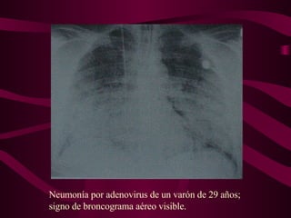 Neumonía por adenovirus de un varón de 29 años; signo de broncograma aéreo visible. 