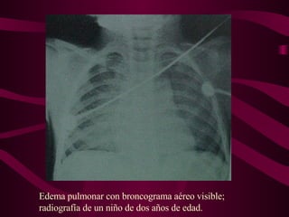Edema pulmonar con broncograma aéreo visible; radiografía de un niño de dos años de edad. 
