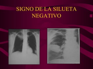 SIGNO DE LA SILUETA NEGATIVO 