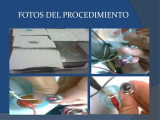FOTOS DEL PROCEDIMIENTO
 