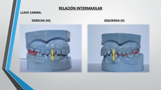 RELACIÓN INTERMAXILARRELACIÓN INTERMAXILAR
LLAVE CANINA.LLAVE CANINA.
DERECHA (III)DERECHA (III) IZQUIERDA (II)IZQUIERDA (II)
 
