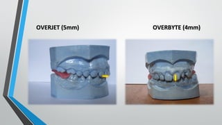 OVERJET (5mm)OVERJET (5mm) OVERBYTE (4mm)OVERBYTE (4mm)
 