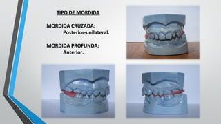 TIPO DE MORDIDATIPO DE MORDIDA
MORDIDA CRUZADA:MORDIDA CRUZADA:
Posterior-unilateral.
MORDIDA PROFUNDA:MORDIDA PROFUNDA:
Anterior.
 