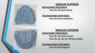 MAXILAR SUPERIORMAXILAR SUPERIOR
ROTACIONES DENTARIASROTACIONES DENTARIAS
Pzas 22, 23 Hacia distal.
INCLINACIONES DENTARIASINCLINACIONES DENTARIAS
Pzas 23 hacia vestibular.
MAXILAR SUPERIORMAXILAR SUPERIOR
ROTACIONES DENTARIAS:ROTACIONES DENTARIAS:
Pzas 35, 45 hacia mesial.
Pzas 34, 33, 32, 42, 43 hacia distal.
INCLINACIONES DENTARIASINCLINACIONES DENTARIAS
Pzas 35 hacia lingual.
 