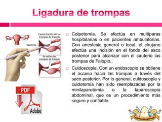  Colpotomía. Se efectúa en multíparas 
hospitalarias o en pacientes ambulatorias. 
Con anestesia general o local, el cirujano 
efectúa una incisión en el fondo del saco 
posterior para alcanzar con el cauterio las 
trompas de Falopio.. 
 Culdoscopia. Con un endoscopio se obtiene 
el acceso hacia las trompas a través del 
saco posterior. Por lo general, culdoscopia y 
culdotomía han sido reemplazadas por la 
minilaparotomía o la laparoscopia 
abdominal, que es un procedimiento más 
seguro y confiable. 
 