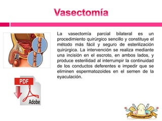 La vasectomía parcial bilateral es un 
procedimiento quirúrgico sencillo y constituye el 
método más fácil y seguro de esterilización 
quirúrgica. La intervención se realiza mediante 
una incisión en el escroto, en ambos lados, y 
produce esterilidad al interrumpir la continuidad 
de los conductos deferentes e impedir que se 
eliminen espermatozoides en el semen de la 
eyaculación. 
 