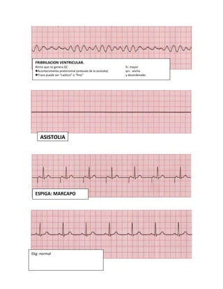 FRIBRILACION VENTRICULAR.
Ritmo que no genera GC fc: mayor
Acontecimiento preterminal (antesala de la asistolia) qrs : ancho
Trazo puede ser “caótico” o “fino” y desordenado.
ASISTOLIA
ESPIGA: MARCAPO
Ekg: normal
 