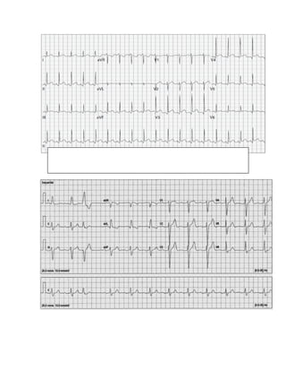 electrocardiograma 1