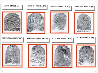 ARCO-SIMPLE (A) ARCO EN TIENDA (T) PRESILLA CUBITAL (U) PRESILLA RADIAL (R)
VERTICILO SIMPLE (W) VERTICILO-CENTRAL (C) V. DOBLE PRESILLA (D)
V. ACCIDENTAL (X)
 