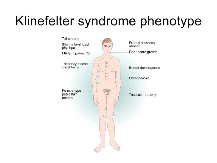 what is klinefelter syndrome Klinefelter syndrome occurs in 1/500-1000 live births and is the most common chromosomal cause of male infertility variants of klinefelter syndrome can include three or more copies of the x chromosome and are typically more severe. what is klinefelter syndrome Klinefelter syndrome occurs in 1/500-1000 live births and is the most common chromosomal cause of male infertility variants of klinefelter syndrome can include three or more copies of the x chromosome and are typically more severe.