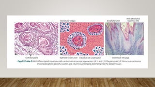 Practical 2 Neoplasia Pptx Pathology Pptx Pptx