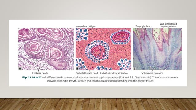 Practical 2 Neoplasia Pptx Pathology Pptx Pptx Cancer Diseases