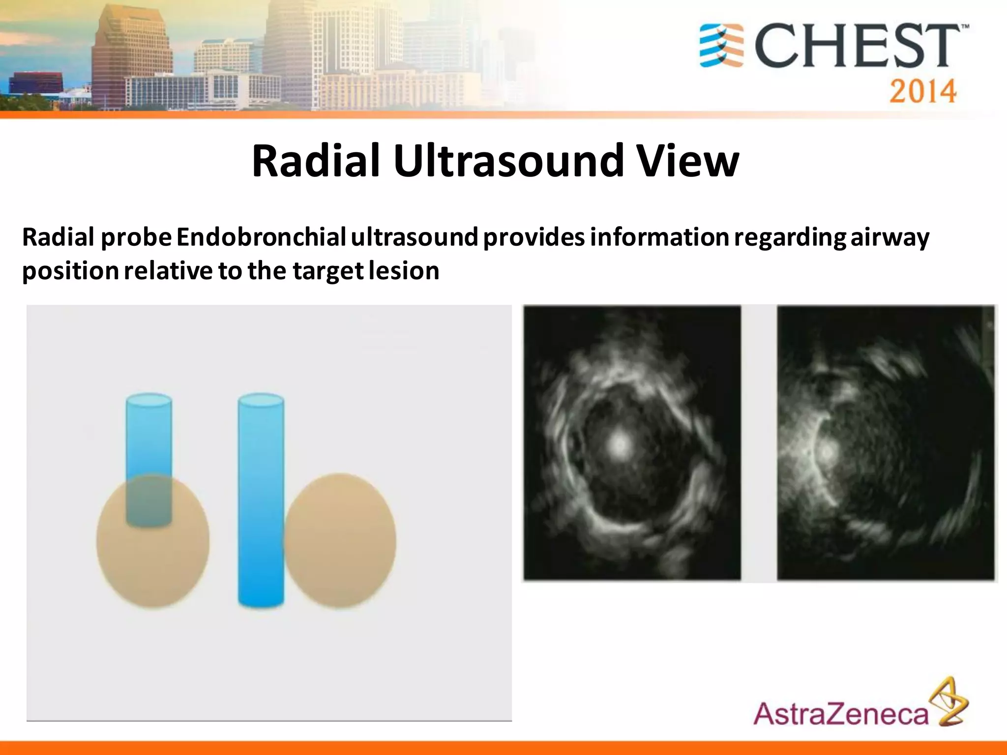 Radial Ultrasound View
Radial probeEndobronchialultrasoundprovides informationregardingairway
positionrelative to the targetlesion
 