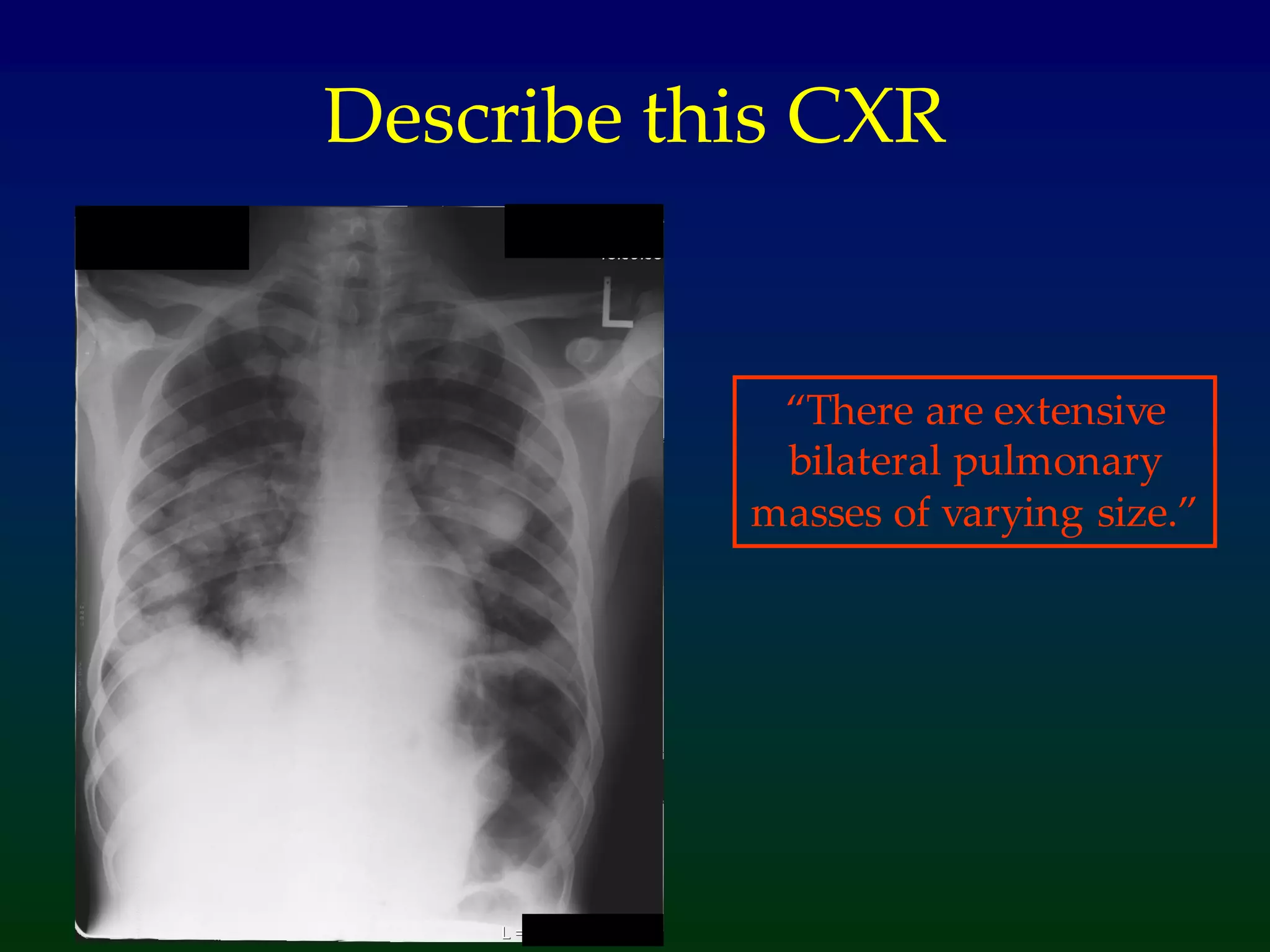 Describe this CXR
“There are extensive
bilateral pulmonary
masses of varying size.”
 