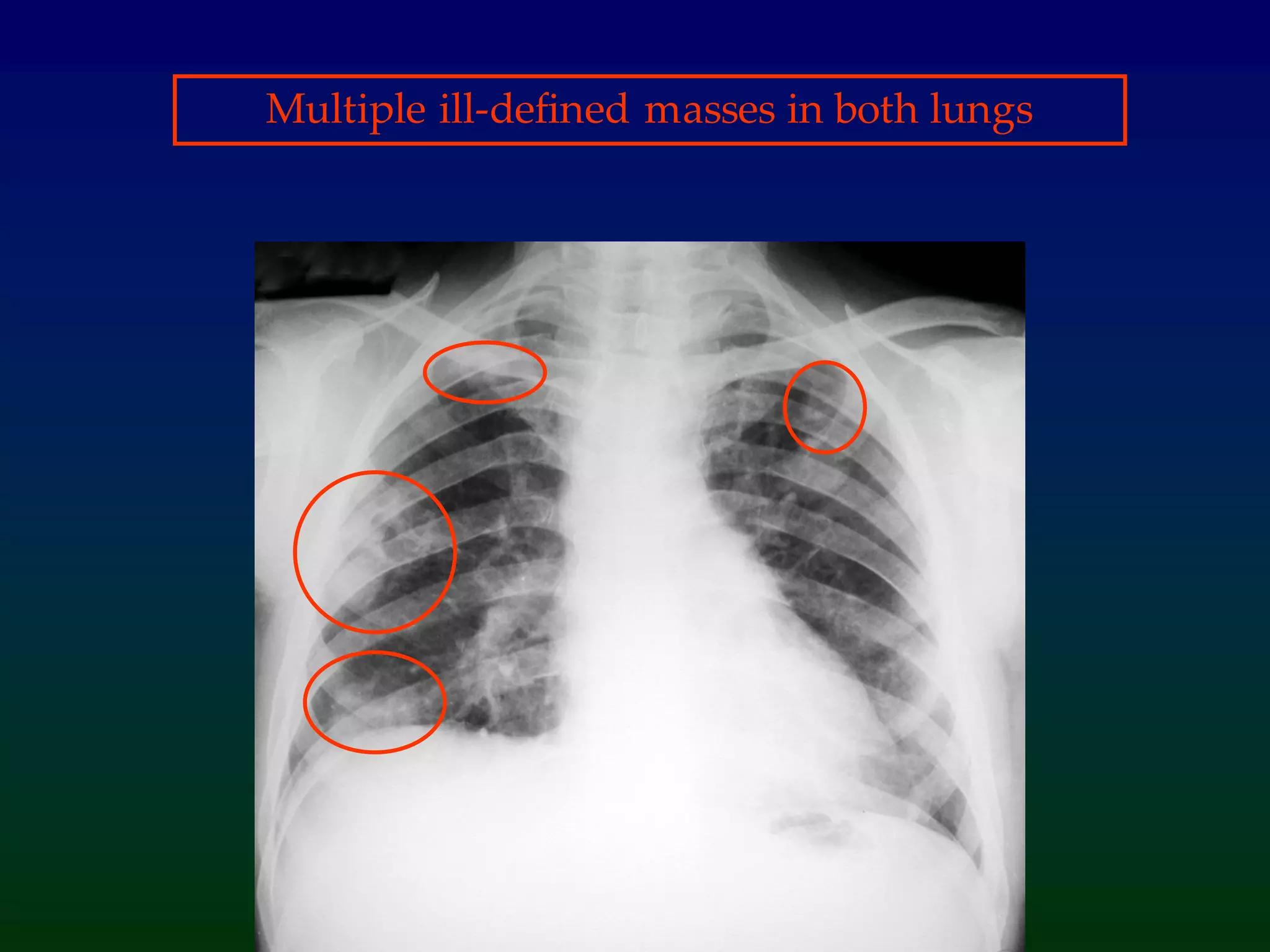 Multiple ill-defined masses in both lungs
 