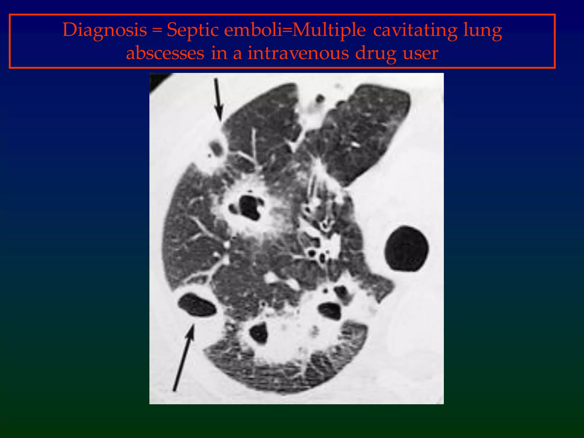 Diagnosis = Septic emboli=Multiple cavitating lung
abscesses in a intravenous drug user
 
