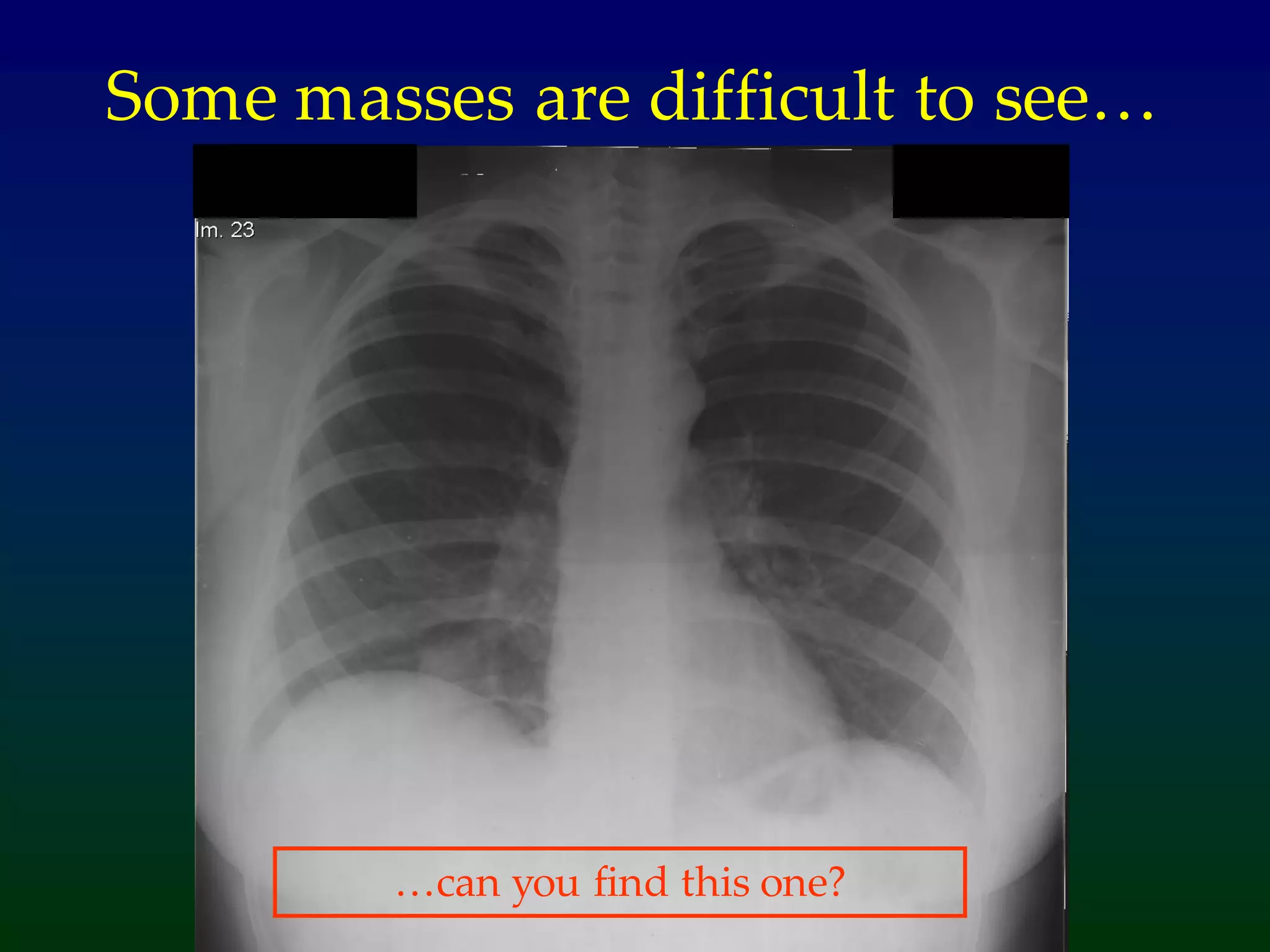 Some masses are difficult to see…
…can you find this one?
 