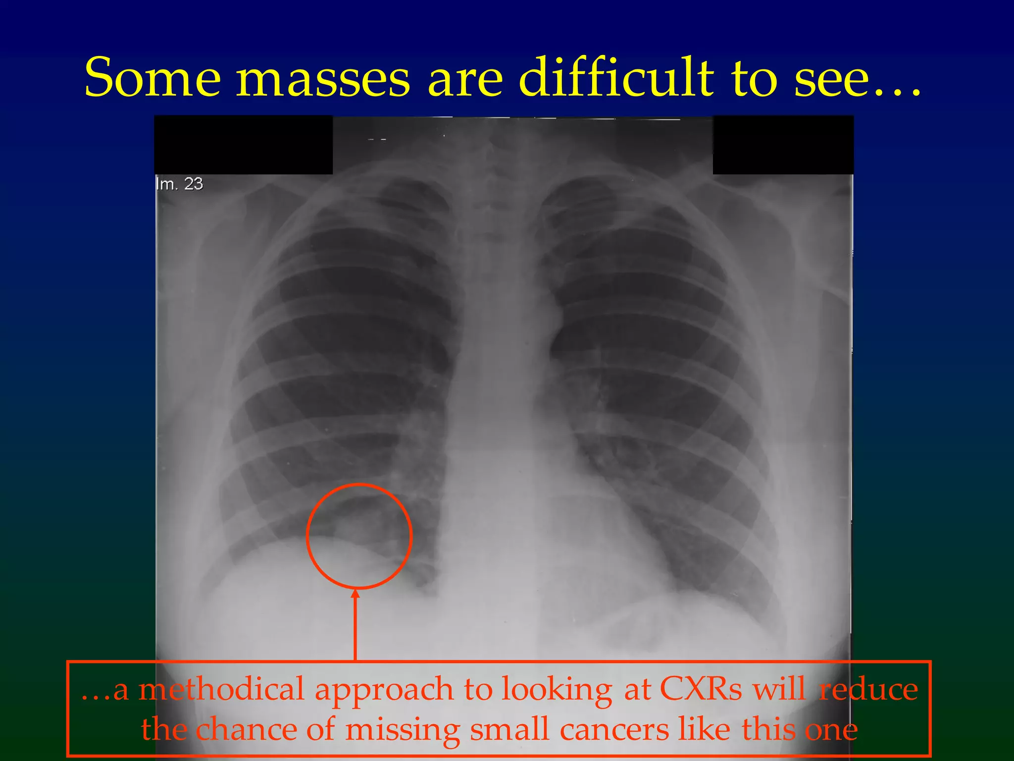 Some masses are difficult to see…
…a methodical approach to looking at CXRs will reduce
the chance of missing small cancers like this one
 