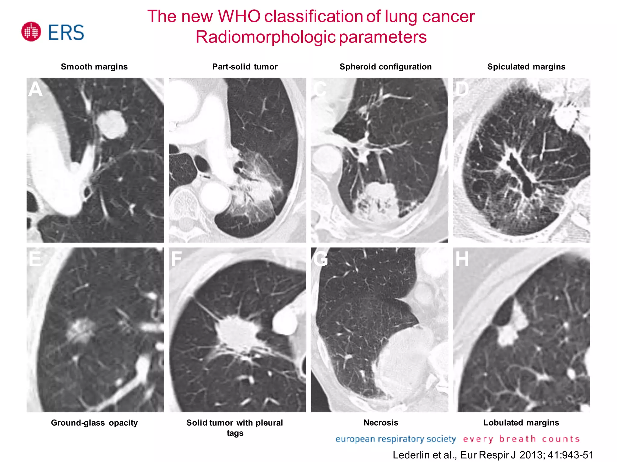The new WHO classificationof lung cancer
Radiomorphologic parameters
A B C
E F G H
D
Smooth margins Part-solid tumor Spheroid configuration Spiculated margins
Ground-glass opacity Solid tumor with pleural
tags
Necrosis Lobulated margins
Lederlin et al., Eur Respir J 2013; 41:943-51
 