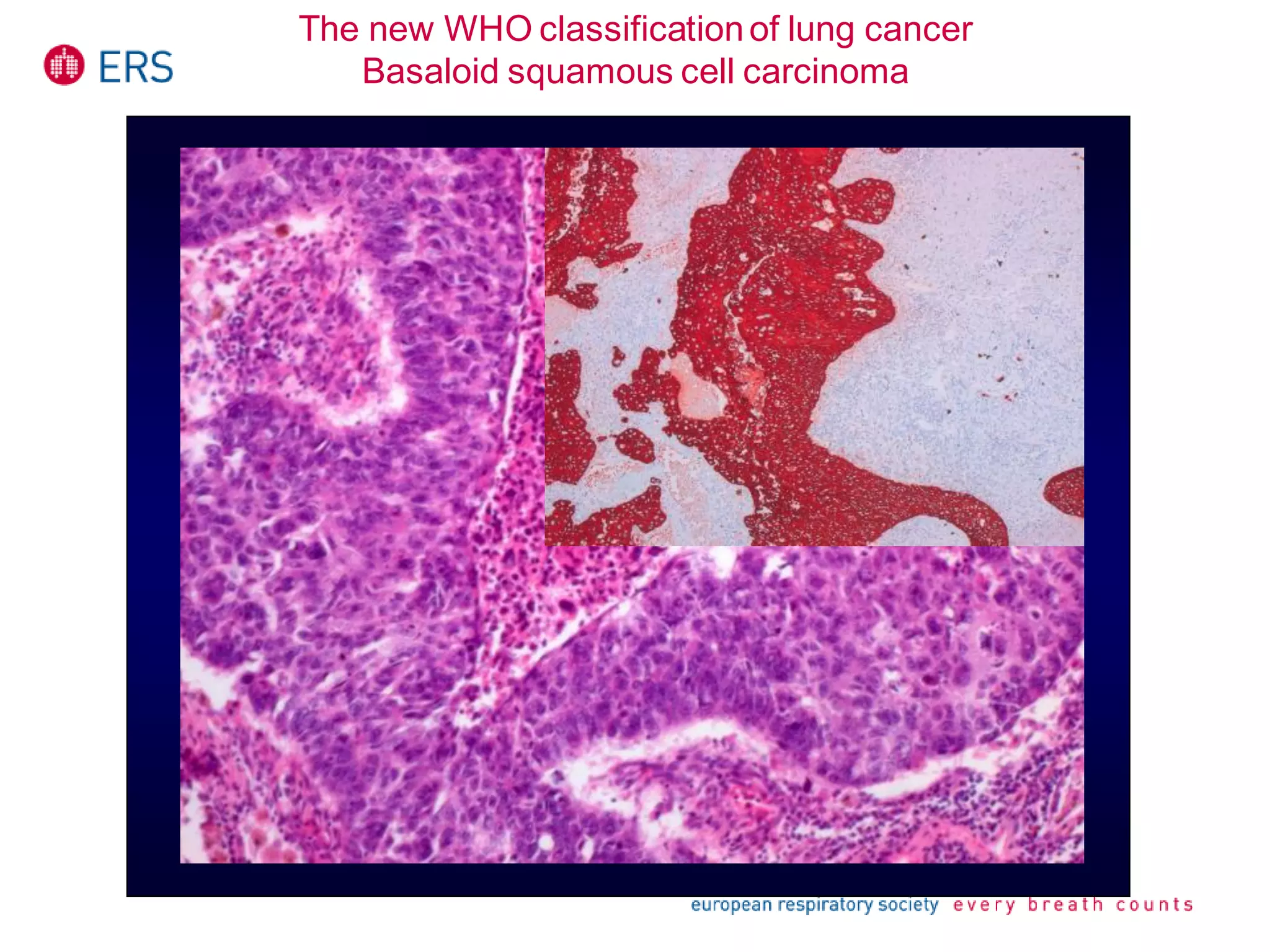 The new WHO classificationof lung cancer
Basaloid squamous cell carcinoma
 