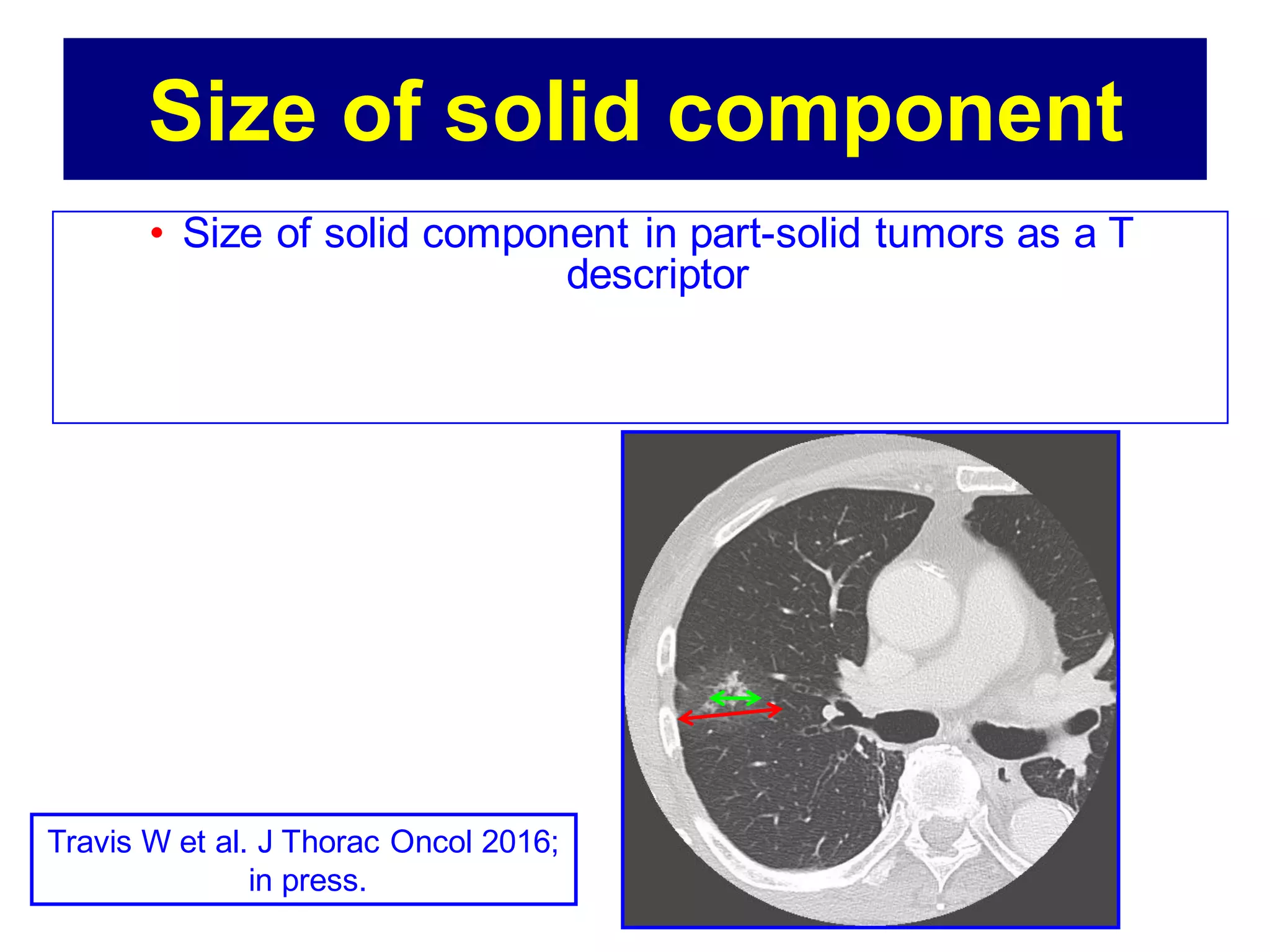 Size of solid component
• Size of solid component in part-solid tumors as a T
descriptor
Travis W et al. J Thorac Oncol 2016;
in press.
 