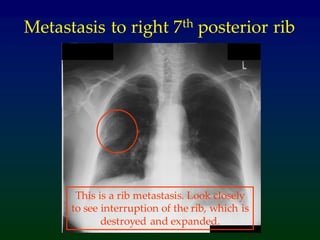 Practical approach to lung cancer | PDF