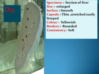 Specimen :- Section of liver
      Size :- enlarged
D13   Surface :-Smooth
      Capsule :-Thin ,stretched easily
      Streped
      Colour :- Yellowish
      Borders :- Rounded
      Consistency:- Soft
 