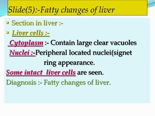 Slide(5):-Fatty changes of liver
 Section in liver :-
 Liver cells :-
 Cytoplasm :- Contain large clear vacuoles
 Nuclei :-Peripheral located nuclei(signet
             ring appearance.
Some intact liver cells are seen.
Diagnosis :- Fatty changes of liver.
 