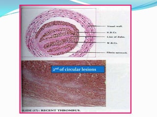 2nd of circular lesions
 