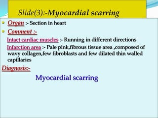 Slide(3):-Myocardial scarring
 Organ :- Section in heart
 Comment :-
  Intact cardiac muscles :- Running in different directions
  Infarction area :- Pale pink,fibrous tissue area ,composed of
  wavy collagen,few fibroblasts and few dilated thin walled
  capillaries
Diagnosis:-
              Myocardial scarring
 