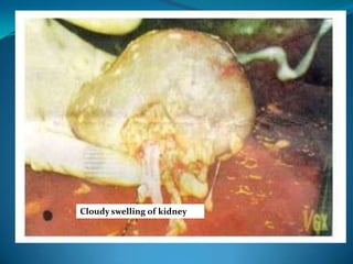 Cloudy swelling of kidney
 