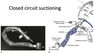 Closed circuit suctioning
 