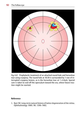 92
Fig. 6.2 Prophylactic treatment of an attached round hole and horseshoe
tear using cryopexy. The round hole at 10:30 is surrounded by 1 row of in-
terrupted cryopexy lesions, as is the horseshoe tear at 1 o’clock. Special
care is taken to seal off the operculum toward the ora, where future trac-
tion might be exerted.
Reference
1. Byer NE. Long-term natural history of lattice degeneration of the retina.
Ophthalmology 1989; 96: 1396−1402.
The Fellow eye
 