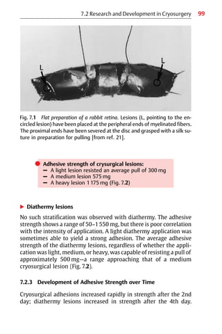 99
쎲 Adhesive strength of crysurgical lesions:
– A light lesion resisted an average pull of 300 mg
– A medium lesion 575 mg
– A heavy lesion 1175 mg (Fig. 7.2)
왘 Diathermy lesions
No such stratification was observed with diathermy. The adhesive
strength shows a range of 50−1550 mg, but there is poor correlation
with the intensity of application. A light diathermy application was
sometimes able to yield a strong adhesion. The average adhesive
strength of the diathermy lesions, regardless of whether the appli-
cation was light, medium, or heavy, was capable of resisting a pull of
approximately 500 mg—a range approaching that of a medium
cryosurgical lesion (Fig. 7.2).
7.2.3 Development of Adhesive Strength over Time
Cryosurgical adhesions increased rapidly in strength after the 2nd
day; diathermy lesions increased in strength after the 4th day.
Fig. 7.1 Flat preparation of a rabbit retina. Lesions (L, pointing to the en-
circled lesion) have been placed at the peripheral ends of myelinated fibers.
The proximal ends have been severed at the disc and grasped with a silk su-
ture in preparation for pulling [from ref. 21].
7.2 Research and Development in Cryosurgery
 