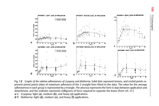 100
a
c
e f
b
d
7
Cryosurgery
Fig. 7.2 Graphs of the relative adhesiveness of cryopexy and diathermy. Solid dots represent lesions, and circled points re-
present joined points (days of maximum adhesion) of the 2 straight lines fitted to the data. The value for the average
adhesiveness in each group is represented by a triangle. The abscissa represents the time in days between application and
detachment, and the ordinate represents milligrams of force required to separate the lesion [from ref. 21.]
a−c Cryopexy: light (a), medium (b), and heavy (c) applications.
d−f Diathermy: light (d), medium (e), and heavy (f) applications.
 