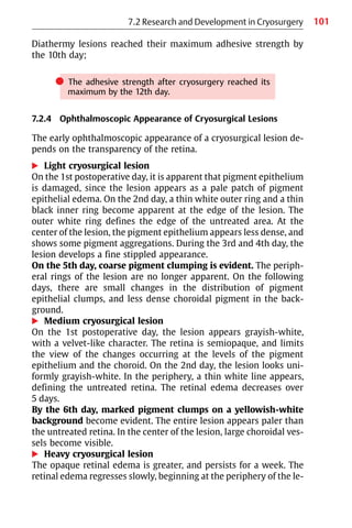 101
Diathermy lesions reached their maximum adhesive strength by
the 10th day;
쎲 The adhesive strength after cryosurgery reached its
maximum by the 12th day.
7.2.4 Ophthalmoscopic Appearance of Cryosurgical Lesions
The early ophthalmoscopic appearance of a cryosurgical lesion de-
pends on the transparency of the retina.
왘 Light cryosurgical lesion
On the 1st postoperative day, it is apparent that pigment epithelium
is damaged, since the lesion appears as a pale patch of pigment
epithelial edema. On the 2nd day, a thin white outer ring and a thin
black inner ring become apparent at the edge of the lesion. The
outer white ring defines the edge of the untreated area. At the
center of the lesion, the pigment epithelium appears less dense, and
shows some pigment aggregations. During the 3rd and 4th day, the
lesion develops a fine stippled appearance.
On the 5th day, coarse pigment clumping is evident. The periph-
eral rings of the lesion are no longer apparent. On the following
days, there are small changes in the distribution of pigment
epithelial clumps, and less dense choroidal pigment in the back-
ground.
왘 Medium cryosurgical lesion
On the 1st postoperative day, the lesion appears grayish-white,
with a velvet-like character. The retina is semiopaque, and limits
the view of the changes occurring at the levels of the pigment
epithelium and the choroid. On the 2nd day, the lesion looks uni-
formly grayish-white. In the periphery, a thin white line appears,
defining the untreated retina. The retinal edema decreases over
5 days.
By the 6th day, marked pigment clumps on a yellowish-white
background become evident. The entire lesion appears paler than
the untreated retina. In the center of the lesion, large choroidal ves-
sels become visible.
왘 Heavy cryosurgical lesion
The opaque retinal edema is greater, and persists for a week. The
retinal edema regresses slowly, beginning at the periphery of the le-
7.2 Research and Development in Cryosurgery
 
