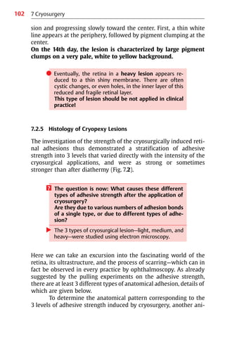 102
sion and progressing slowly toward the center. First, a thin white
line appears at the periphery, followed by pigment clumping at the
center.
On the 14th day, the lesion is characterized by large pigment
clumps on a very pale, white to yellow background.
쎲 Eventually, the retina in a heavy lesion appears re-
duced to a thin shiny membrane. There are often
cystic changes, or even holes, in the inner layer of this
reduced and fragile retinal layer.
This type of lesion should be not applied in clinical
practice!
7.2.5 Histology of Cryopexy Lesions
The investigation of the strength of the cryosurgically induced reti-
nal adhesions thus demonstrated a stratification of adhesive
strength into 3 levels that varied directly with the intensity of the
cryosurgical applications, and were as strong or sometimes
stronger than after diathermy (Fig. 7.2).
? The question is now: What causes these different
types of adhesive strength after the application of
cryosurgery?
Are they due to various numbers of adhesion bonds
of a single type, or due to different types of adhe-
sion?
왘 The 3 types of cryosurgical lesion—light, medium, and
heavy—were studied using electron microscopy.
Here we can take an excursion into the fascinating world of the
retina, its ultrastructure, and the process of scarring—which can in
fact be observed in every practice by ophthalmoscopy. As already
suggested by the pulling experiments on the adhesive strength,
there are at least 3 different types of anatomical adhesion, details of
which are given below.
To determine the anatomical pattern corresponding to the
3 levels of adhesive strength induced by cryosurgery, another ani-
7 Cryosurgery
 