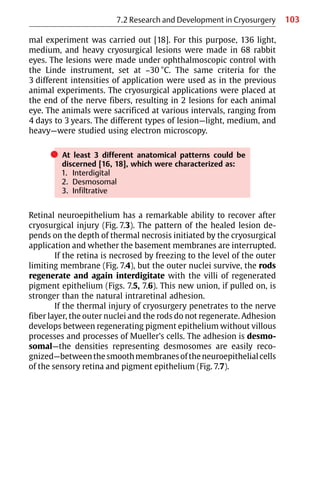 103
mal experiment was carried out [18]. For this purpose, 136 light,
medium, and heavy cryosurgical lesions were made in 68 rabbit
eyes. The lesions were made under ophthalmoscopic control with
the Linde instrument, set at −30 °C. The same criteria for the
3 different intensities of application were used as in the previous
animal experiments. The cryosurgical applications were placed at
the end of the nerve fibers, resulting in 2 lesions for each animal
eye. The animals were sacrificed at various intervals, ranging from
4 days to 3 years. The different types of lesion—light, medium, and
heavy—were studied using electron microscopy.
쎲 At least 3 different anatomical patterns could be
discerned [16, 18], which were characterized as:
1. Interdigital
2. Desmosomal
3. Infiltrative
Retinal neuroepithelium has a remarkable ability to recover after
cryosurgical injury (Fig. 7.3). The pattern of the healed lesion de-
pends on the depth of thermal necrosis initiated by the cryosurgical
application and whether the basement membranes are interrupted.
If the retina is necrosed by freezing to the level of the outer
limiting membrane (Fig. 7.4), but the outer nuclei survive, the rods
regenerate and again interdigitate with the villi of regenerated
pigment epithelium (Figs. 7.5, 7.6). This new union, if pulled on, is
stronger than the natural intraretinal adhesion.
If the thermal injury of cryosurgery penetrates to the nerve
fiber layer, the outer nuclei and the rods do not regenerate. Adhesion
develops between regenerating pigment epithelium without villous
processes and processes of Mueller’s cells. The adhesion is desmo-
somal—the densities representing desmosomes are easily reco-
gnized—betweenthesmoothmembranesoftheneuroepithelialcells
of the sensory retina and pigment epithelium (Fig. 7.7).
7.2 Research and Development in Cryosurgery
 