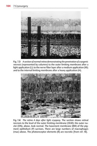 104
OLM
ON
BM
R
P
mac
7 Cryosurgery
Fig. 7.3 A section of normal retina demonstrating the penetration of cryogenic
necrosis (represented by columns) to the outer limiting membrane after a
light application (L); to the nerve fiber layer after a medium application (M);
and to the internal limiting membrane after a heavy application (H).
Fig. 7.4 The retina 4 days after light cryopexy. The section shows retinal
necrosis to the level of the outer limiting membrane (OLM); the outer nu-
clei (ON), above, look normal. The basement membrane (BM) of the pig-
ment epithelium (P) survives. There are large numbers of macrophages
(mac) above. The photoreceptor elements (R) are necrotic [from ref. 18].
 