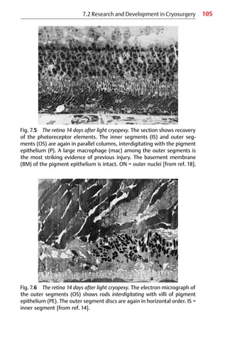 105
Fig. 7.5 The retina 14 days after light cryopexy. The section shows recovery
of the photoreceptor elements. The inner segments (IS) and outer seg-
ments (OS) are again in parallel columns, interdigitating with the pigment
epithelium (P). A large macrophage (mac) among the outer segments is
the most striking evidence of previous injury. The basement membrane
(BM) of the pigment epithelium is intact. ON = outer nuclei [from ref. 18].
7.2 Research and Development in Cryosurgery
Fig. 7.6 The retina 14 days after light cryopexy. The electron micrograph of
the outer segments (OS) shows rods interdigitating with villi of pigment
epithelium (PE). The outer segment discs are again in horizontal order. IS =
inner segment [from ref. 14].
 