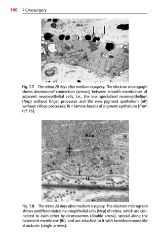 106
Fig. 7.8 The retina 28 days after medium cryopexy. The electron micrograph
shows undifferentiated neuroepithelial cells (Nep) of retina, which are con-
nected to each other by desmosomes (double arrow), spread along the
basement membrane (Ib), and are attached to it with hemidesmosome-like
structures (single arrows).
7 Cryosurgery
Fig. 7.7 The retina 28 days after medium cryopexy. The electron micrograph
shows desmosomal connection (arrows) between smooth membranes of
adjacent neuroepithelial cells, i.e., the less specialized neuroepithelium
(Nep) without finger processes and the new pigment epithelium (nP)
without villous processes; lb = lamina basalis of pigment epithelium [from
ref. 16].
 