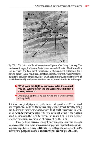 107
Fig. 7.9 The retina and Bruch’s membrane 2 years after heavy cryopexy. The
electron micrograph shows a chorioretinal scar by infiltration. The thermal in-
jury necrosed the basement membrane of the pigment epithelium (lb =
lamina basalis). As a result regenerating retinal neuroepithelium (Nep) infil-
trated the collagen lamellae (Col) of Bruch’s membrane, crossed the level of
elastic lamina (el), and penetrated into the adjacent choroid. Fc = fibrocyte.
7.2 Research and Development in Cryosurgery
? What does this tight desmosomal adhesion remind
you of? Where else in the eye would you find such a
strong adhesion?
왘 Analogous epithelial relationships are found over the
ciliary body.
If the recovery of pigment epithelium is delayed, undifferentiated
neuroepithelial cells of the retina may even spread directly along
the basement membrane and attach to it, with structures resem-
bling hemidesmosomes (Fig. 7.8). The residual retina is then a thin
band of neuroepithelium between the inner limiting membrane
and the basement membrane of pigment epithelium.
Finally, if the thermal injury by cryosurgery is severe enough
to necrose the basement membrane of pigment epithelium, surviv-
ing neuroepithelium may infiltrate the collagen lamellae of Bruch’s
membrane [20] and cause a chorioretinal scar (Figs. 7.9, 7.10).
 