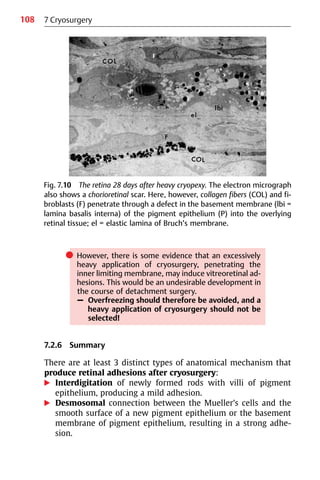 108
쎲 However, there is some evidence that an excessively
heavy application of cryosurgery, penetrating the
inner limiting membrane, may induce vitreoretinal ad-
hesions. This would be an undesirable development in
the course of detachment surgery.
– Overfreezing should therefore be avoided, and a
heavy application of cryosurgery should not be
selected!
7.2.6 Summary
There are at least 3 distinct types of anatomical mechanism that
produce retinal adhesions after cryosurgery:
왘 Interdigitation of newly formed rods with villi of pigment
epithelium, producing a mild adhesion.
왘 Desmosomal connection between the Mueller’s cells and the
smooth surface of a new pigment epithelium or the basement
membrane of pigment epithelium, resulting in a strong adhe-
sion.
Fig. 7.10 The retina 28 days after heavy cryopexy. The electron micrograph
also shows a chorioretinal scar. Here, however, collagen fibers (COL) and fi-
broblasts (F) penetrate through a defect in the basement membrane (lbi =
lamina basalis interna) of the pigment epithelium (P) into the overlying
retinal tissue; el = elastic lamina of Bruch’s membrane.
7 Cryosurgery
 