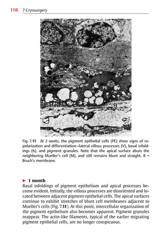 110
왘 1 month
Basal infoldings of pigment epithelium and apical processes be-
come evident. Initially, the villous processes are disoriented and lo-
cated between adjacent pigment epithelial cells. The apical surfaces
continue to exhibit stretches of blunt cell membranes adjacent to
Mueller’s cells (Fig. 7.11). At this point, intercellular organization of
the pigment epithelium also becomes apparent. Pigment granules
reappear. The actin-like filaments, typical of the earlier migrating
pigment epithelial cells, are no longer conspicuous.
Fig. 7.11 At 3 weeks, the pigment epithelial cells (PE) show signs of re-
polarization and differentiation—lateral villous processes (V), basal infold-
ings (b), and pigment granules. Note that the apical surface abuts the
neighboring Mueller’s cell (M), and still remains blunt and straight. B =
Bruch’s membrane.
7 Cryosurgery
 